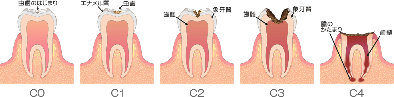 虫歯の進行