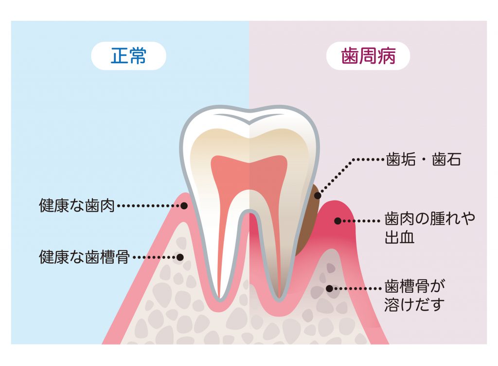 正常な歯と歯周病