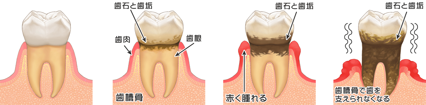 歯周病の進行